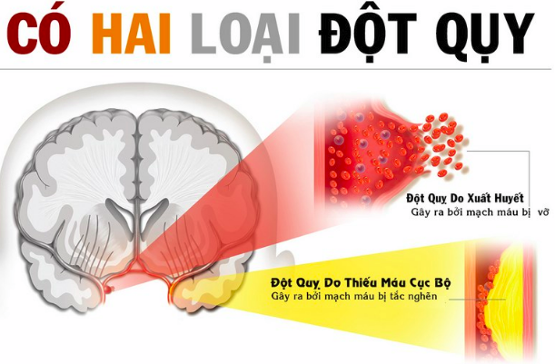 Nghiên cứu dùng an cung cho bệnh nhân xuất huyết não