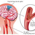 Bệnh Tai Biến Mạch Máu Não Có Di Chứng Gì? Triệu Chứng? Khám Ở Đâu?