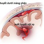 Tai Biến Mạch Máu Não Có Chữa Được Không? Mẹo Chữa Theo Y Học Cổ Truyền?