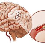 Tai Biến Mạch Máu Não Có Di Truyền Không? Nguy Hiểm Không? Tỷ Lệ Mắc Tại Việt Nam